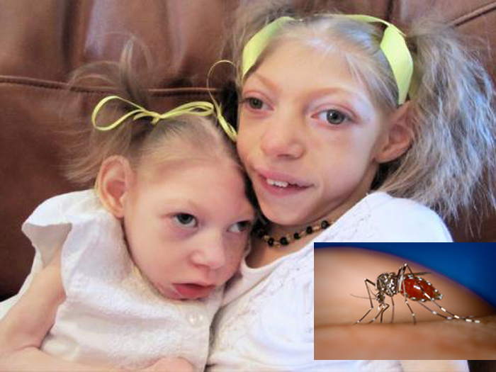Sử dụng bồn nước Sơn Hà ngăn ngừa Virus Zika "ăn não người"